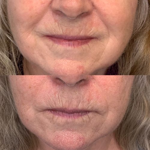 Procell before and after at studio Ki